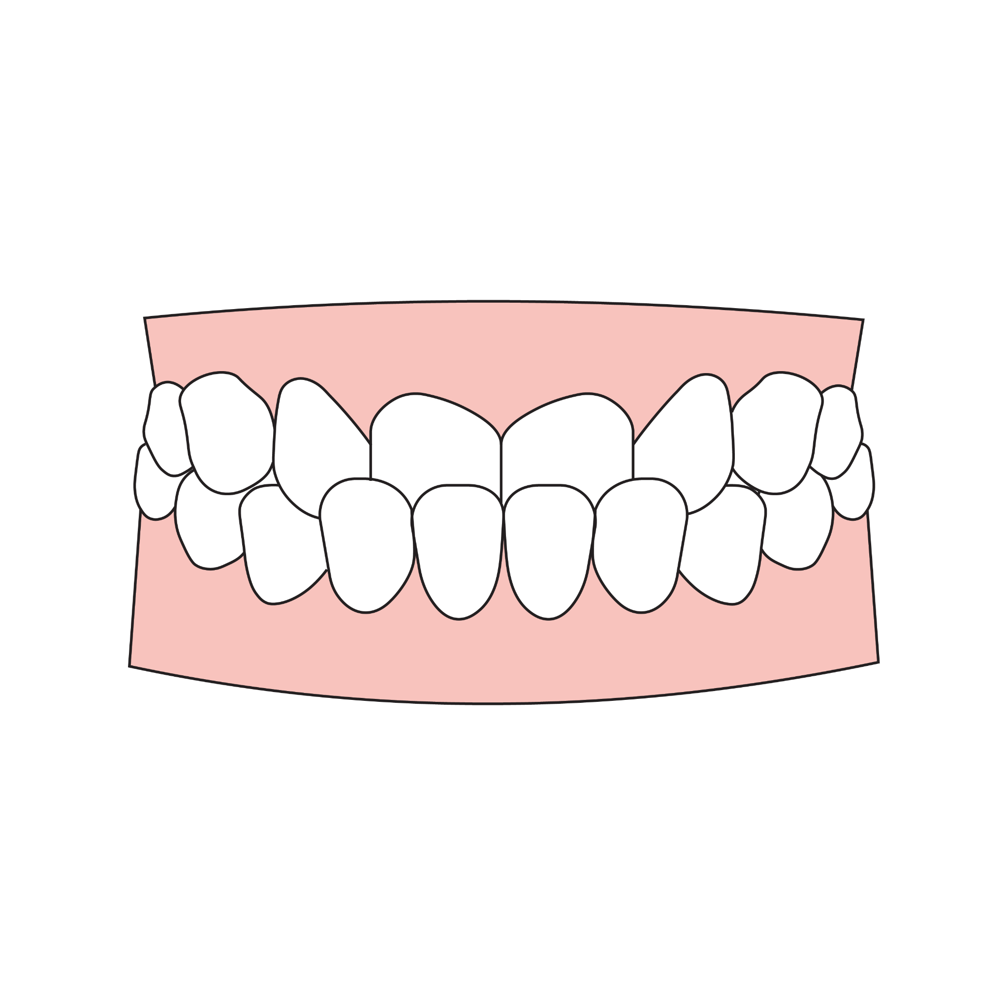 Underbite